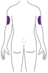 Alternativa injektionsställen